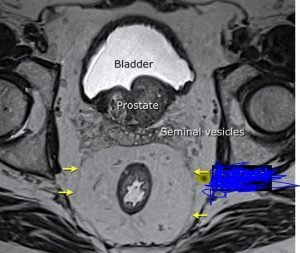 Rectum MRI