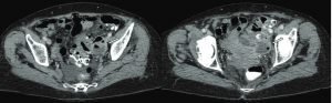 Sigmoid Diverticulitis