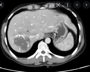CT Liver
