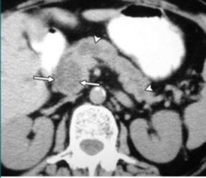 pANCREAS MCQ