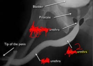 Male urethera MCQ