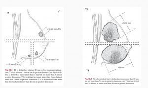 TNM Breast