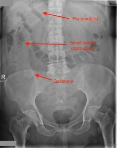 Gall stone and intesinal obstruction